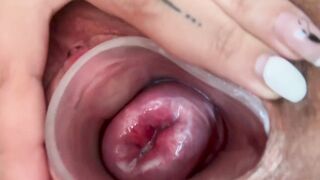 Small cervix without dilating